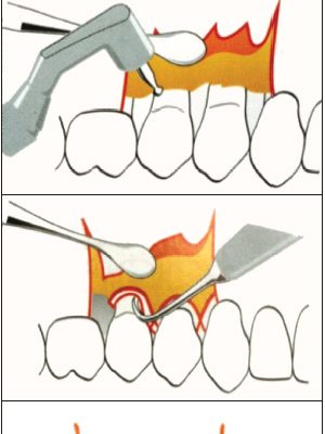 9.3CIRUGIA-PERIODONTAL 9.3CIRUGIA-PERIODONTAL
